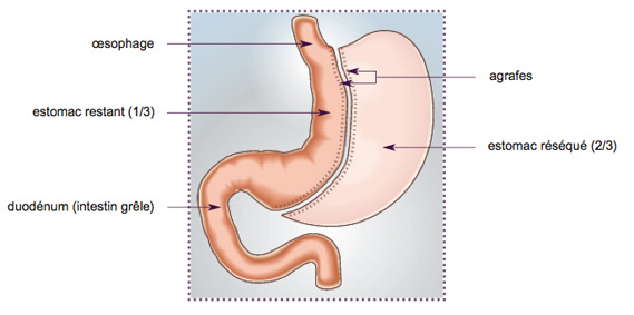 gastrectomie-longitudinale